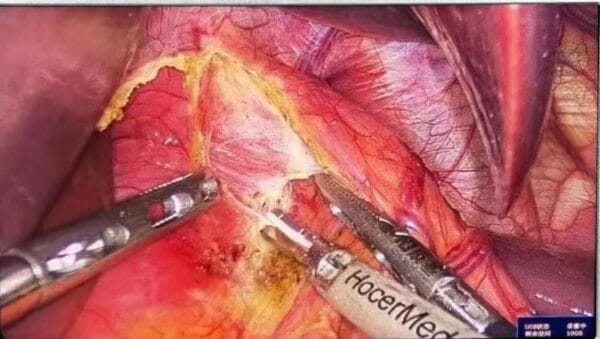 Endoscopy Operative Integrated Portable Unit For Laparoscopy Hysteroscopy Full HD - Image 2