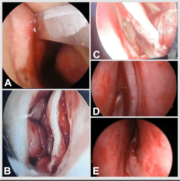 Medical Surgical Endoscopy Camera For Ent Neuro Otology